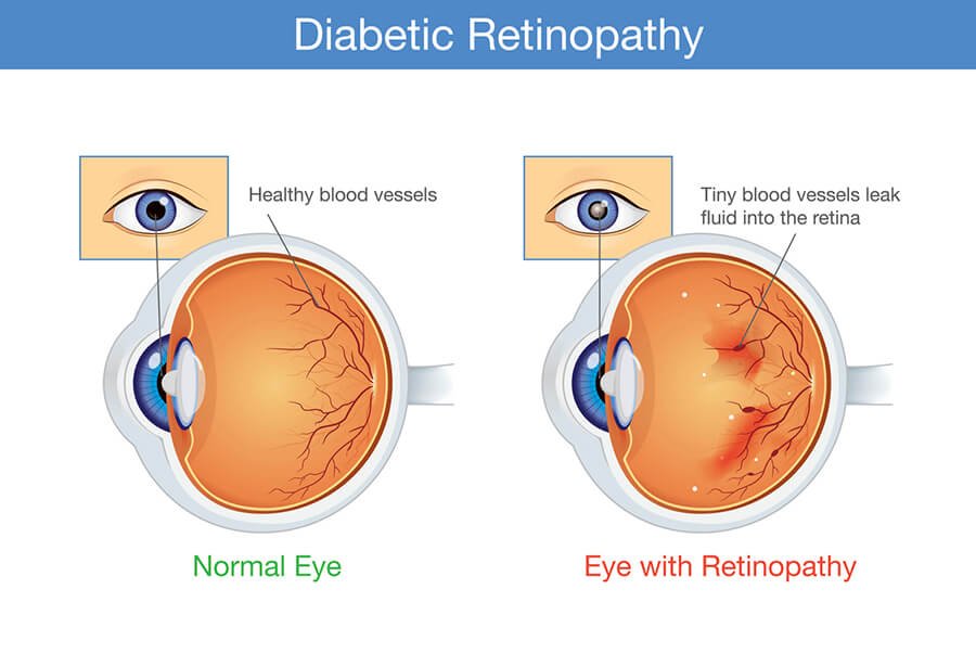 Chart Illustrating a normal eye compared to one with retinopathy
