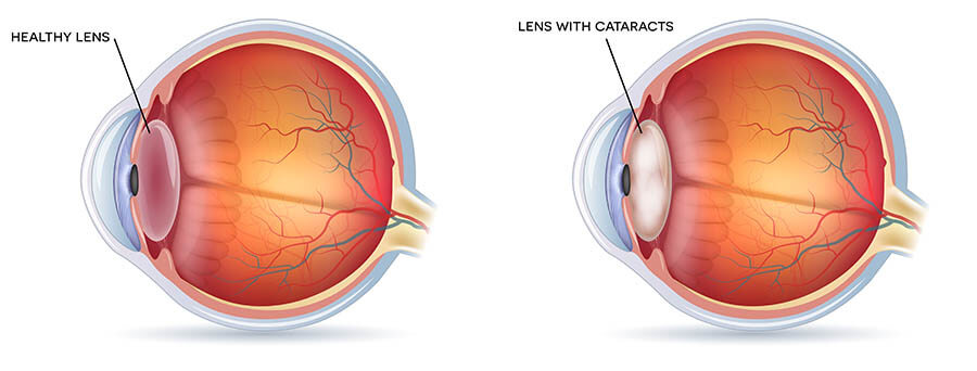 Chart Illustrating a Healthy Lens Compared to One With a Cataract