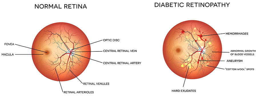 Chart Illustrating a Normal Retina Compared to one With Diabetic Retinopathy